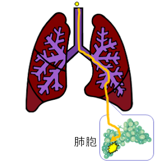 イラスト：pm2.5と肺胞の図